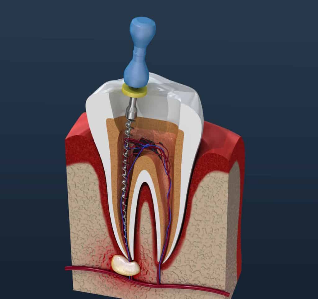 What are the Symptoms of a Root Canal?