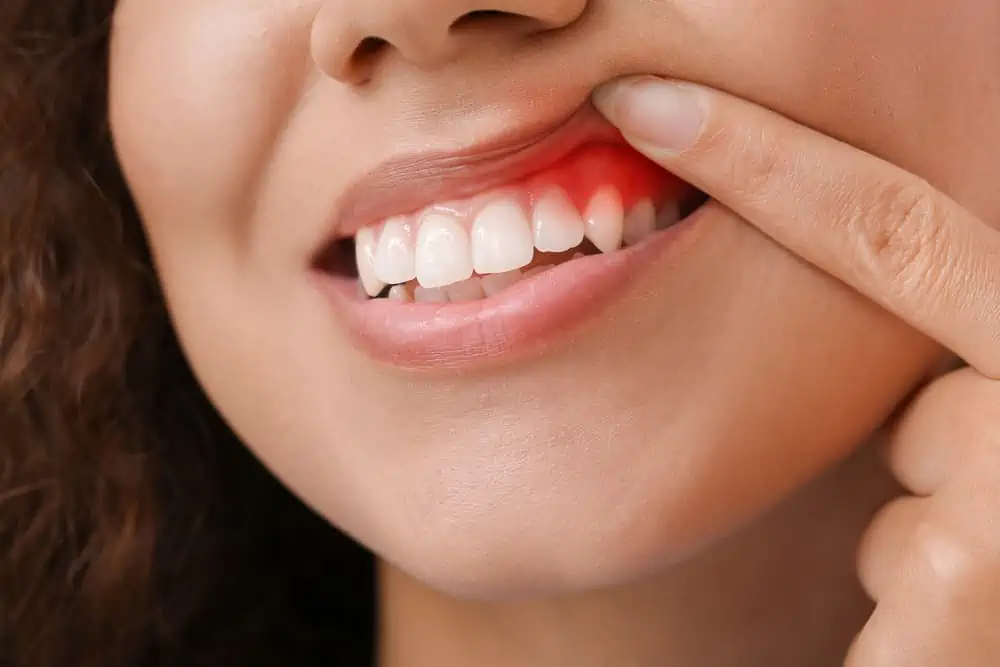 Symptoms and Causes of Gingivitis