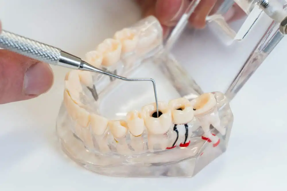 Root Canal