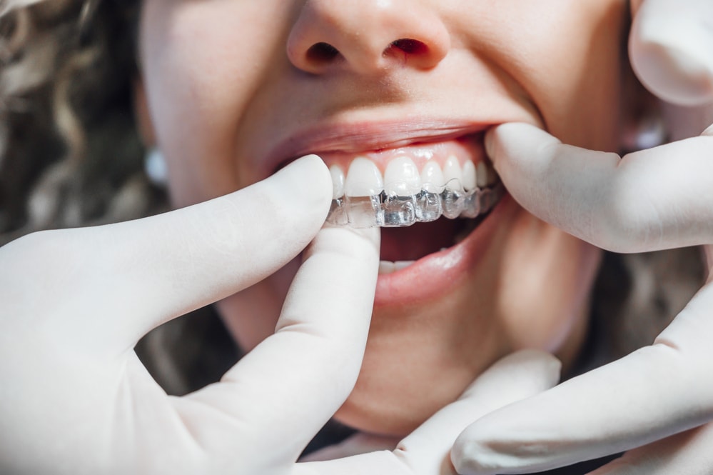 Invisalign Cleaning Guide: Maintain Clarity, Preserve Health